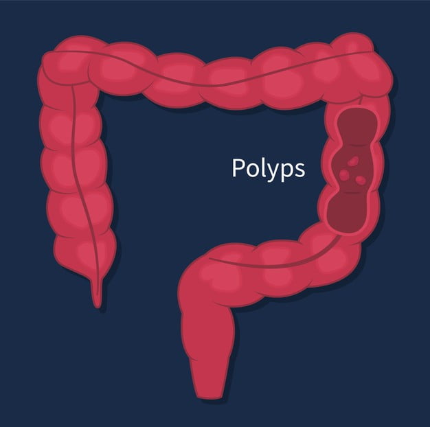 section intestine with polyps 341076 179